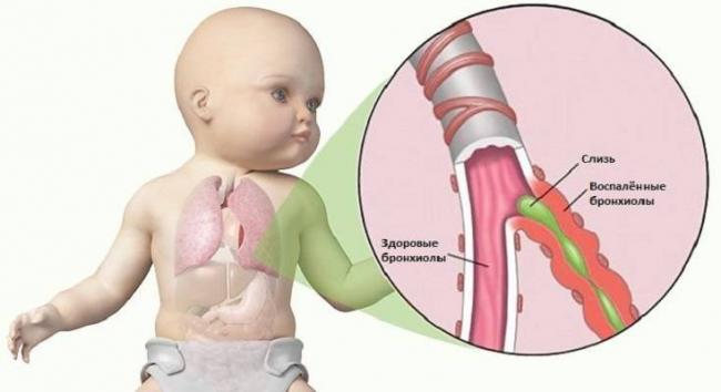 Способы лечения бронхита народными средствами у детей