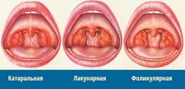 Бактериальный тонзиллит: лечение, симптомы, осложнения