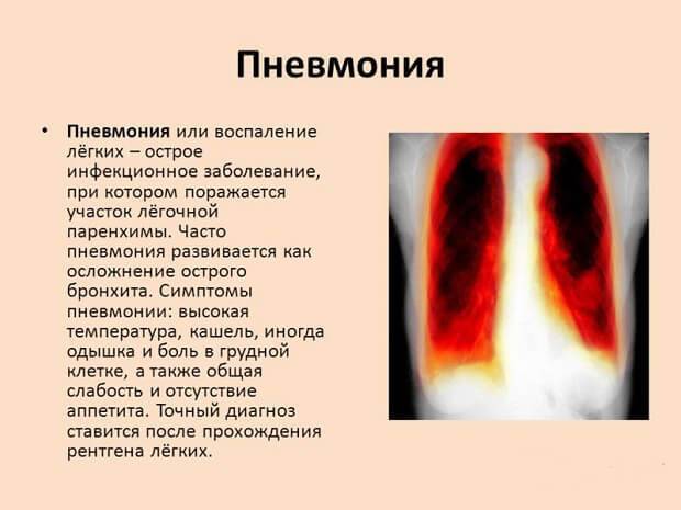 Симптомы и лечение прикорневой пневмонии
