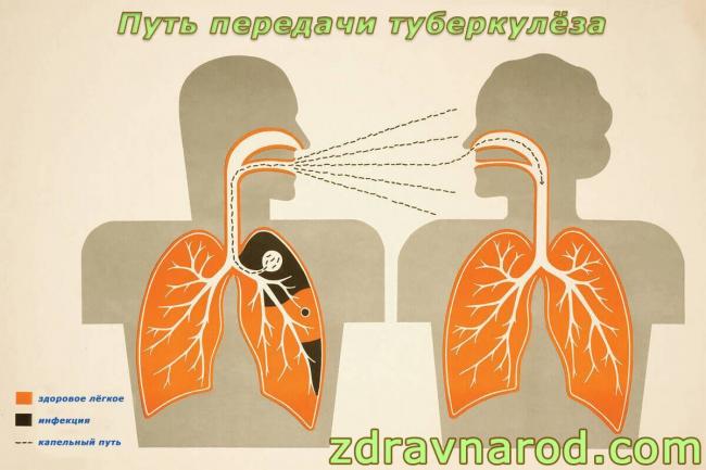 Можно ли лечить туберкулез дома