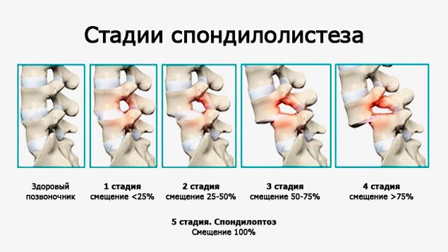 Спондилолистез пояснично-крестцового отдела позвоночника - что это такое?