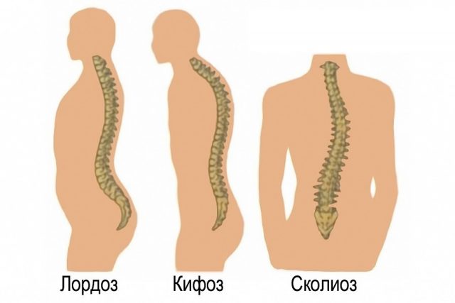 Как исправить искривление позвоночника у детей и подростков: зарядка, лфк, упражнения, гимнастика, массаж