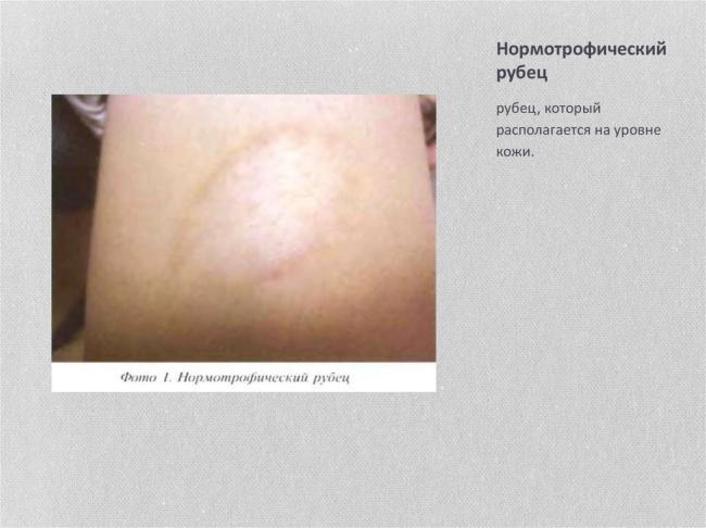 Почему образуются рубцы и шрамы, способы устранения дефекта