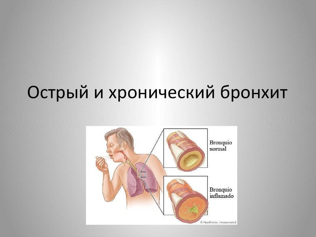 Хронический бронхит у взрослых: признаки, симптомы хронического обструктивного бронхита, лечение