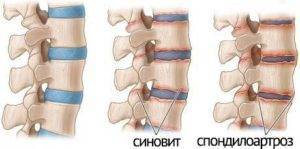 Остеохондроз спондилоартроз спондилез грудного отдела позвоночника