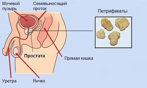 Простатит