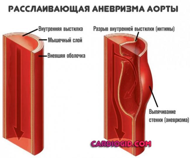 Аневризма брюшной аорты – симптомы, лечение, операция, разрыв
