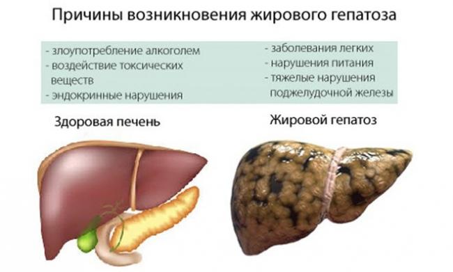 Диета при циррозе печени: меню и рецепты