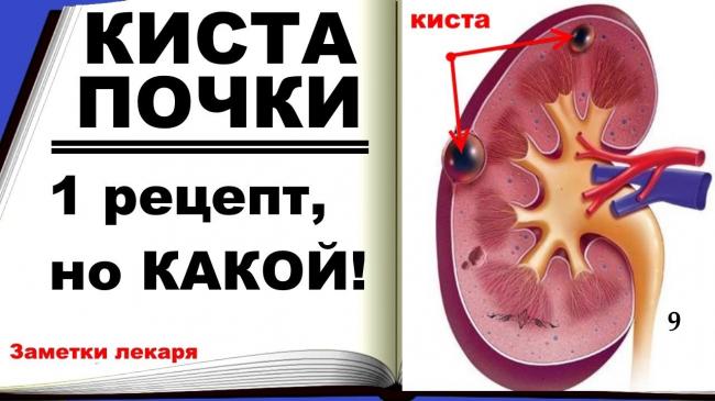 Киста почки: как правильно лечить и избежать осложнений