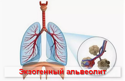 Идиопатический фиброзирующий альвеолит