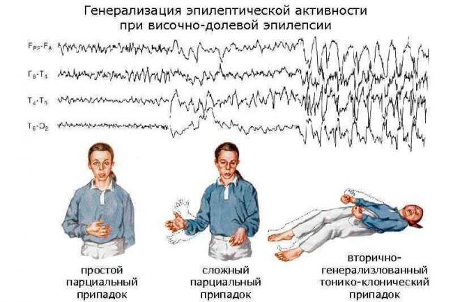 Абсанс