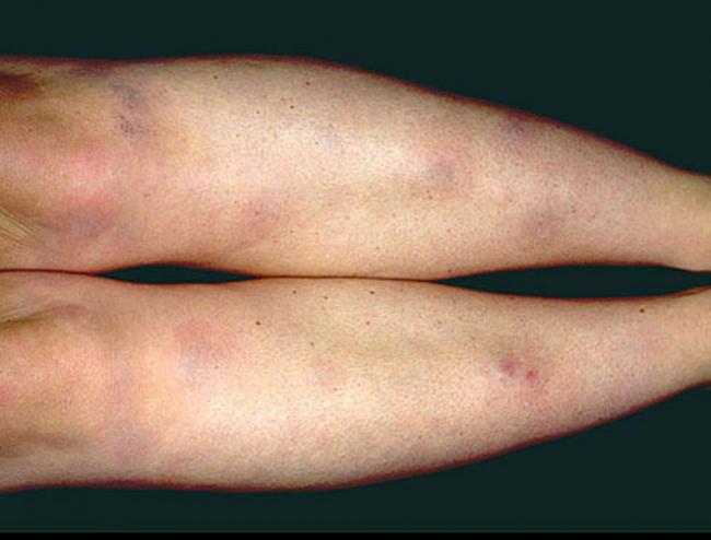 Streptococcus mitis: характеристика, патогенность, симптомы, лечение
