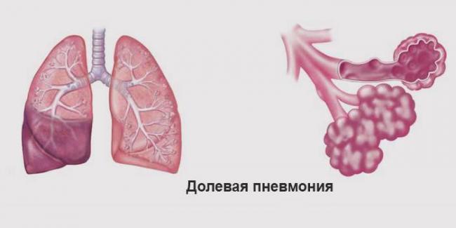 Застойная пневмония у лежачих больных: симптомы, лечение, профилактика