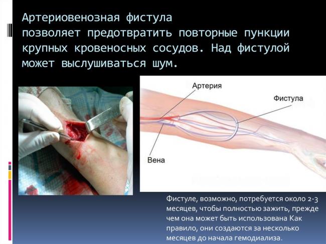 Артериовенозный свищ