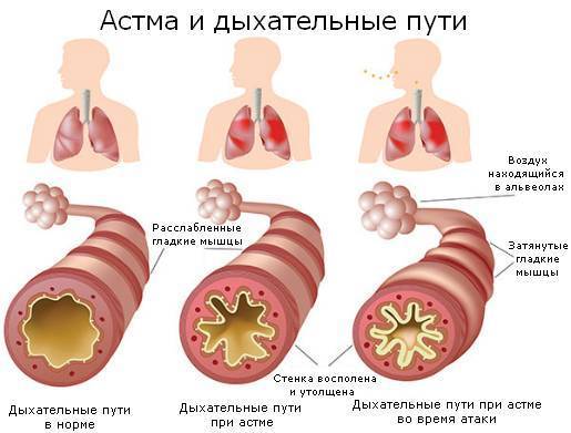 Ингалятор при астме