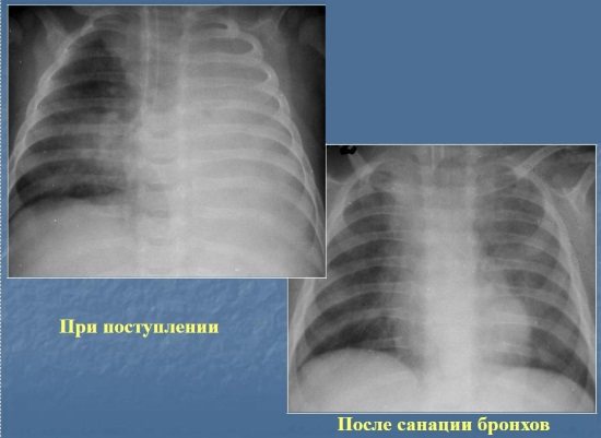 Последствия пневмонии у взрослых и осложнения после лечения