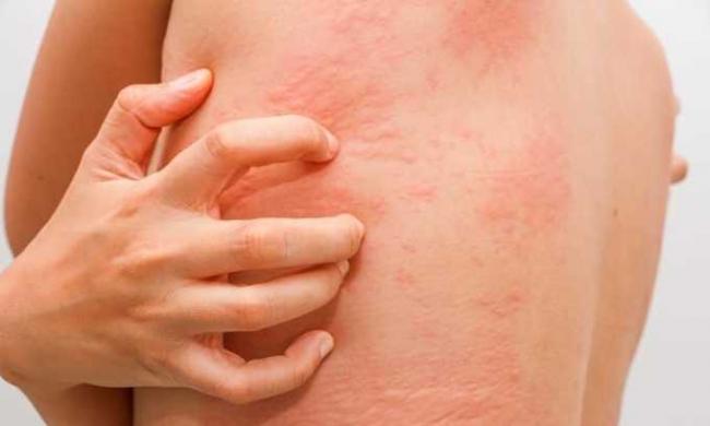 Дипроспан