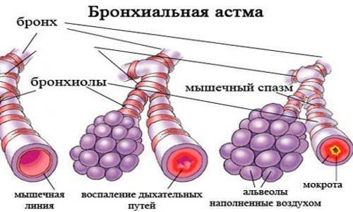 Астма передается по наследству ребенку