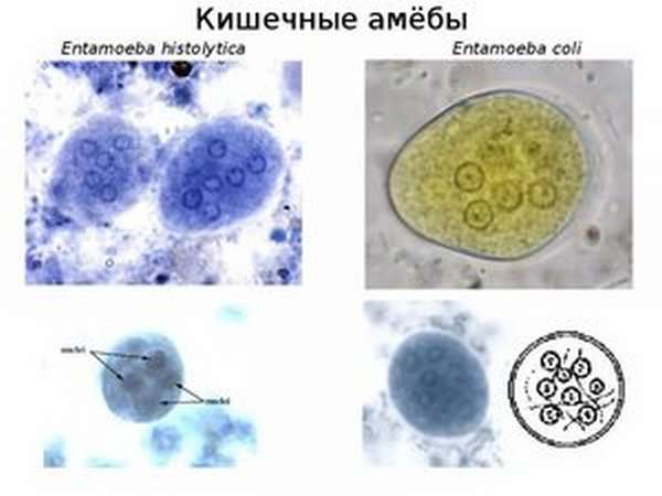 Что такое амебиаз