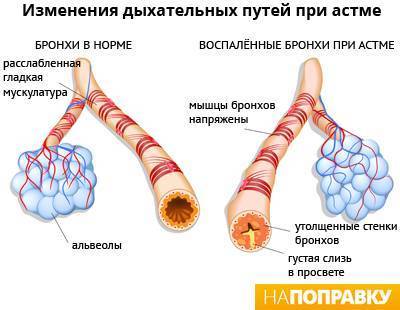 Обострение бронхиальной астмы: лечение и профилактика