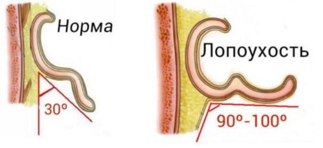 Лопоухость, торчат оттопыренные уши: причины, методы лечения