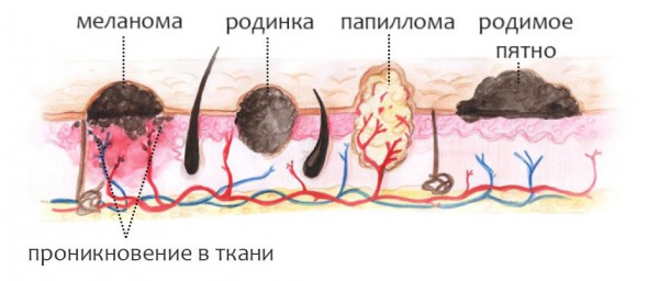 Меланома кожи фото начальная стадия симптомы лечение на ноге