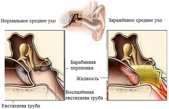 Острый и хронический тубоотит — что это такое