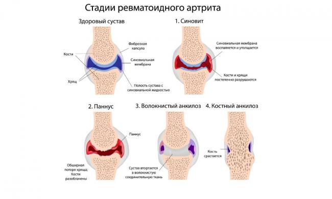Диета при полиартрите