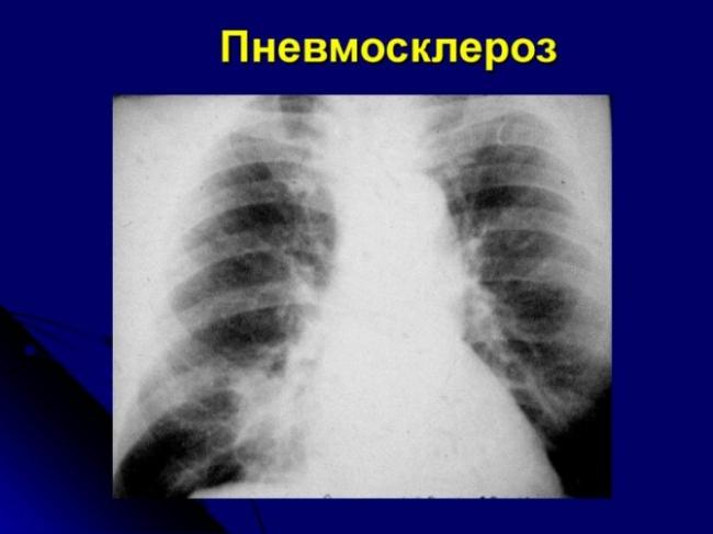 Диффузный пневмосклероз легких – что это такое, сколько живут? — симптомы