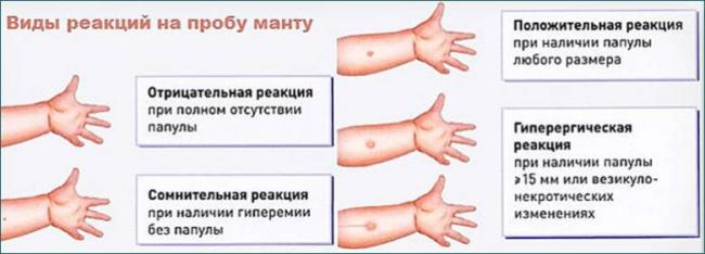 Признаки и симптомы туберкулеза у детей. основные меры профилактики