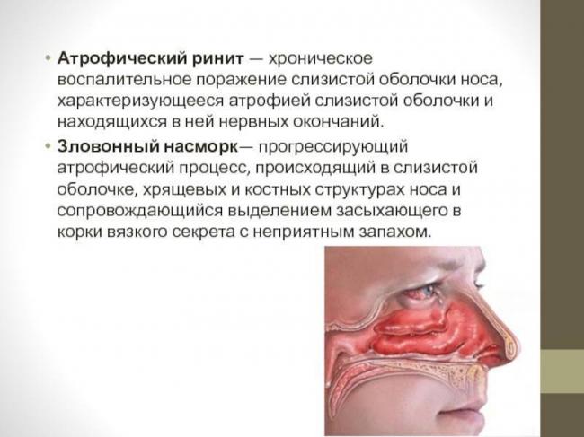 Хронические воспалительные заболевания полости носа - симптомы болезни, профилактика и лечение хронических воспалительных заболеваний полости носа, причины заболевания и его диагностика на eurolab