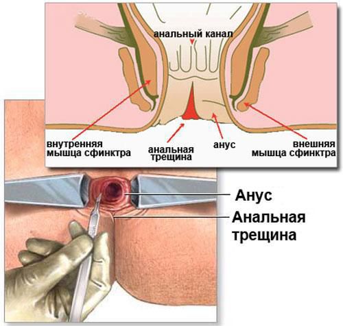 Хроническая анальная трещина