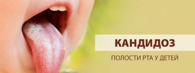 Капли кандид при молочнице во рту у ребенка