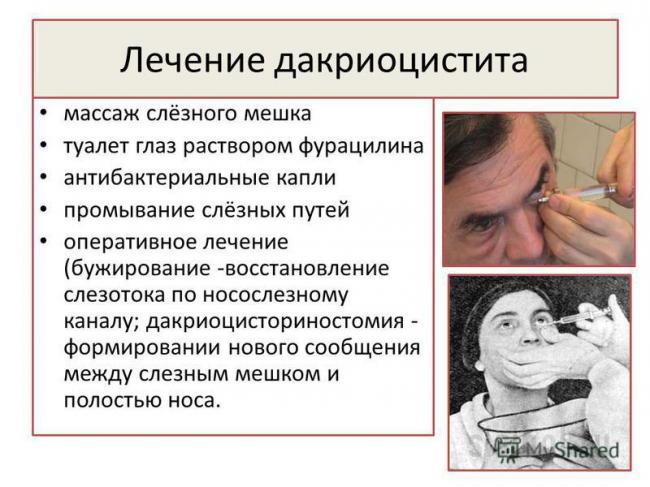Лечение дакриоаденит