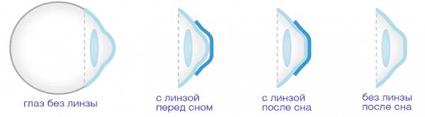 Ортокератология: годовой опыт использования ночных линз
