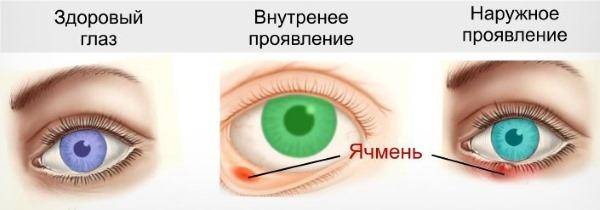 Доктор комаровский о том, как лечить ячмень на глазу у ребенка