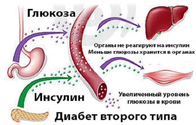 Сахарный диабет