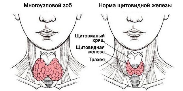 Причины и лечебные меры при диффузном и узловом нетоксическом зобе щитовидки