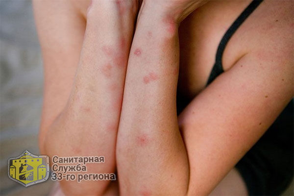 Чем мазать укусы постельных клопов, средства из аптеки и народная медицина