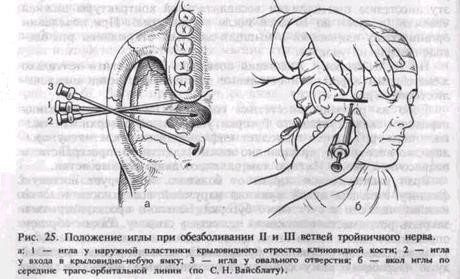 Неврит и невралгия тройничного нерва: причины, симптомы и лечение