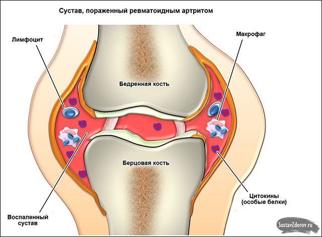 Лечение ревматоидного артрита