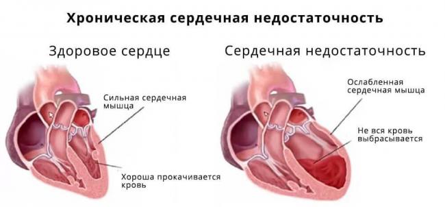 Валсартан: инструкция, аналоги, при каком давлении принимать таблетки?