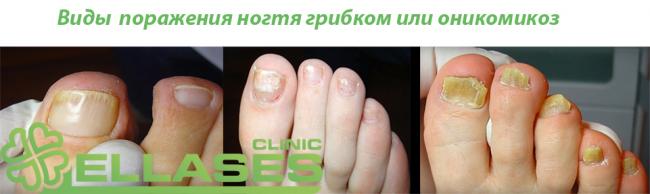 Онихомикоз — каждый четвертый болел, болеет или еще заболеет им!
