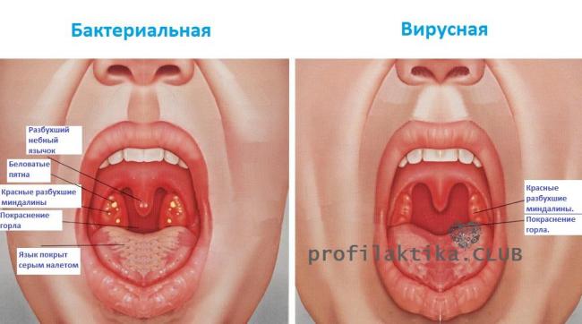 Абсцессы в лор-практике: паратонзиллярный, горла, о флегмонах, лечение