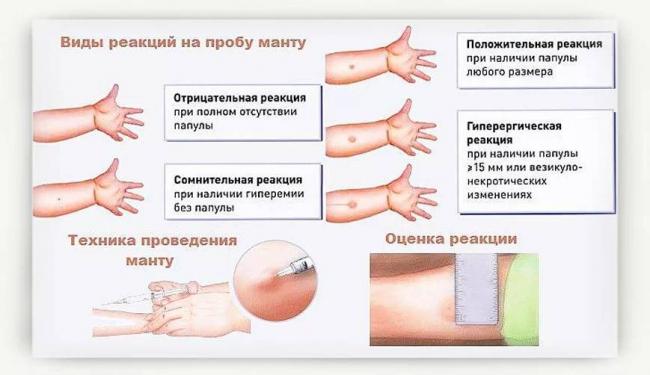 Как выглядит положительный результат диаскинтеста и что делать?
