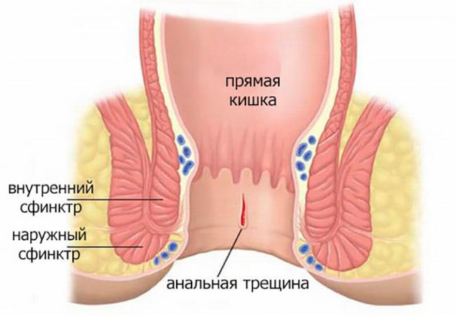 Анальная трещина: причины, лечение, прогноз — онлайн-диагностика