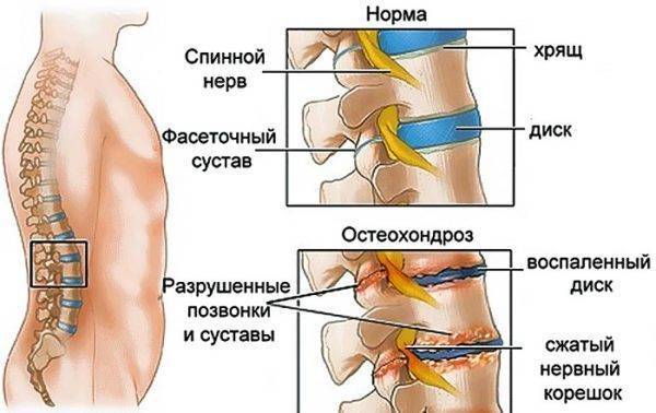 Жжение в спине в области лопаток