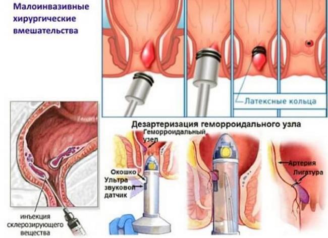 Геморрой у женщин