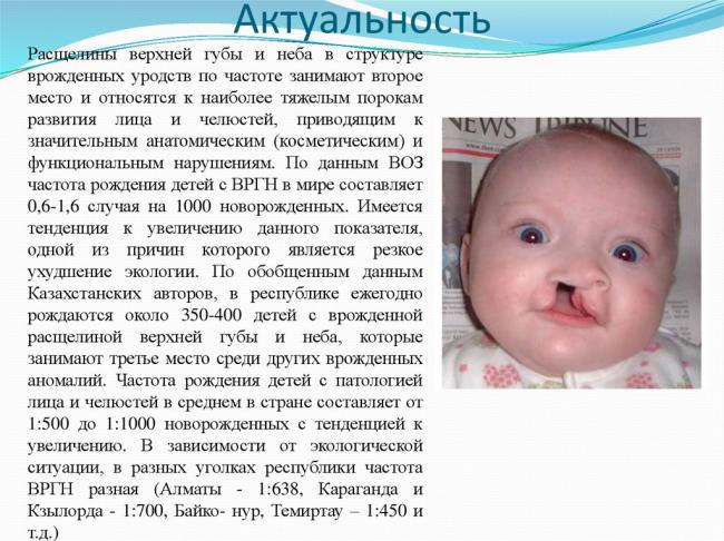 Волчья пасть. причины, симптомы, пластическая операция и реабилитация :: polismed.com