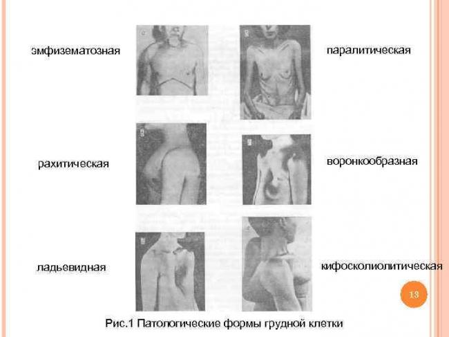 Деформация грудной клетки у ребенка